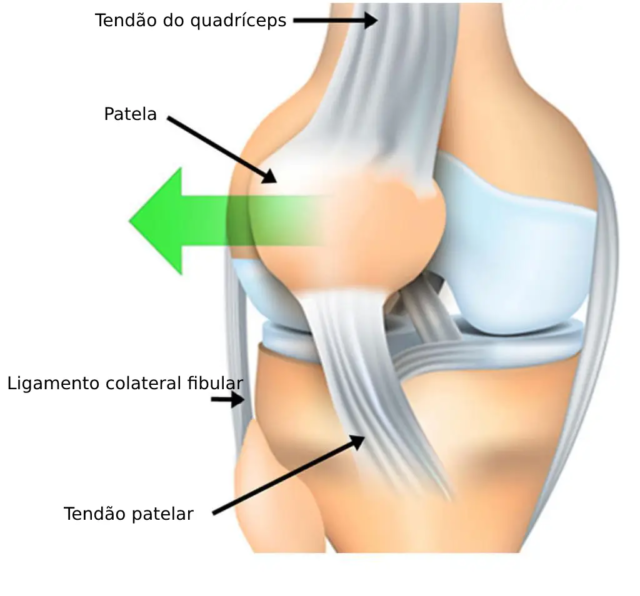 Deslocamento lateral da patela quando há instabilidade ou luxação