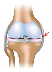 Imagem anatômica demonstrando o local comum de rompimento do ligamento colateral medial do joelho.
