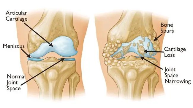 A osteoartrite frequentemente resulta em fricção de osso contra osso. Esporos ósseos são uma característica comum dessa forma de artrite.